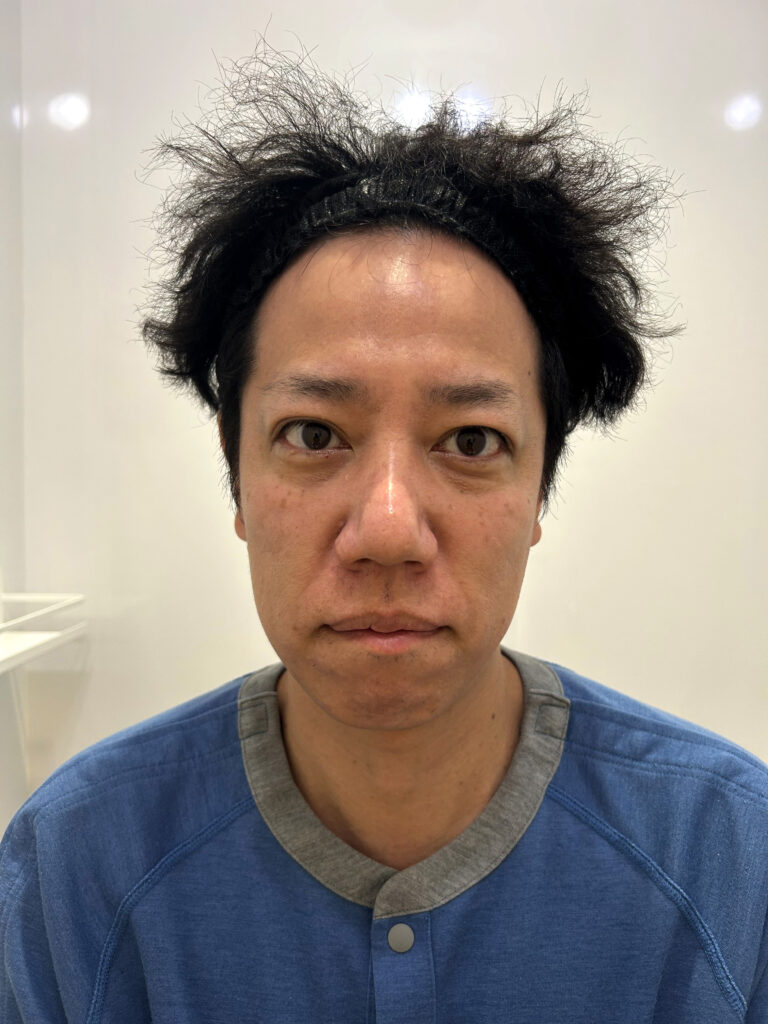 金の糸・施術前撮影